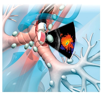 Иллюстрация процедуры EBUS TBNA