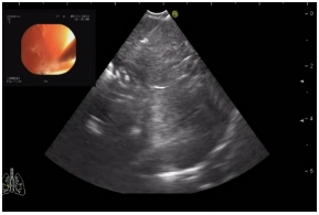 Ультразвуковая картина, получаемая при пункции лимфоузла