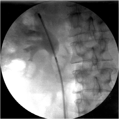фиброуретеропиелоскоп в полостной системе почки