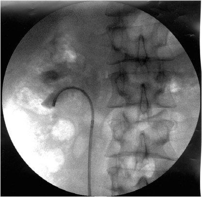 фиброуретеропиелоскоп в полостной системе почки